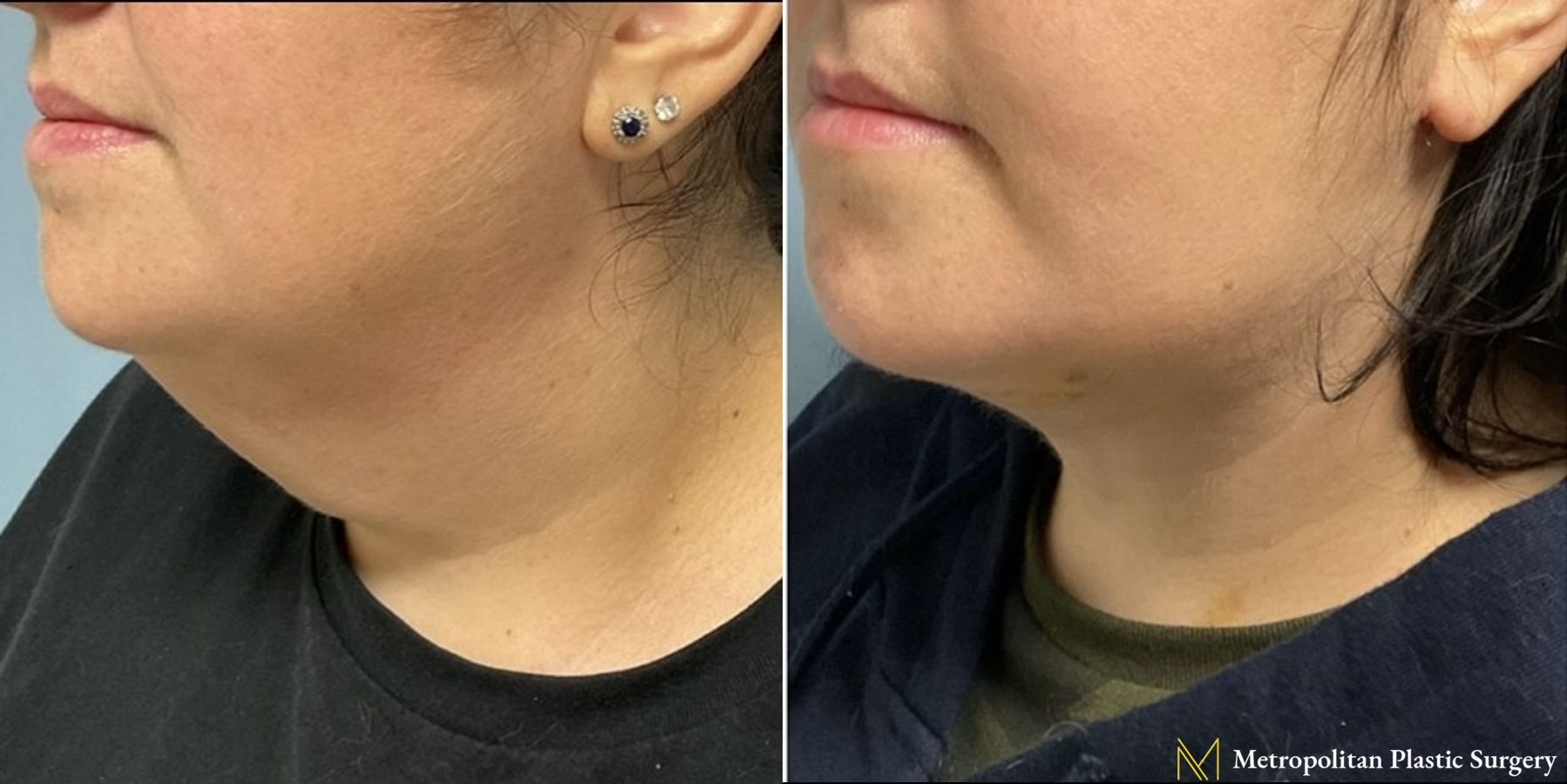 Before and after Facelift & Neck Lift case 8077