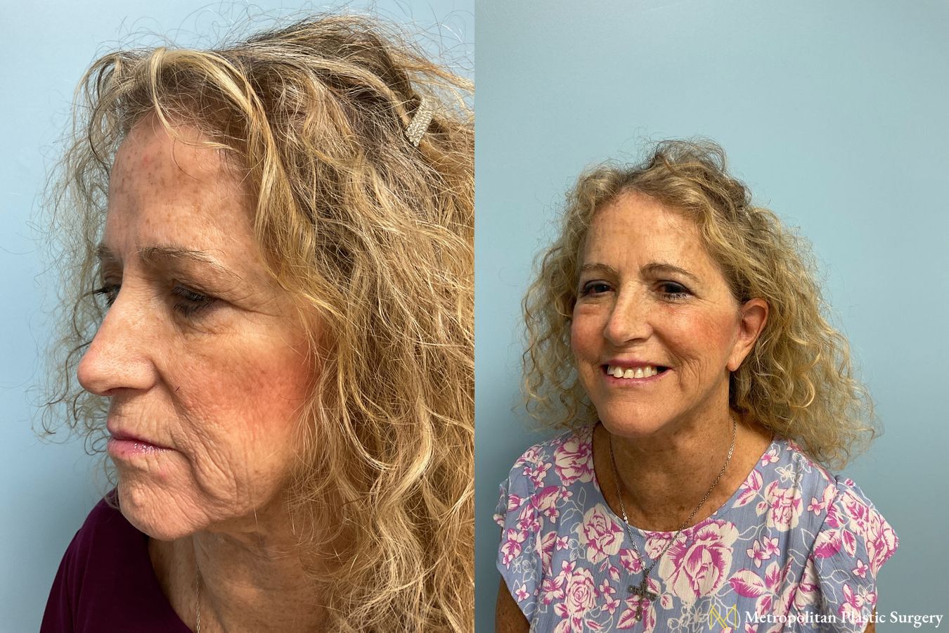 Before and after face lift (rhytidectomy) neck lift from Julia Spears MD - Angle 4