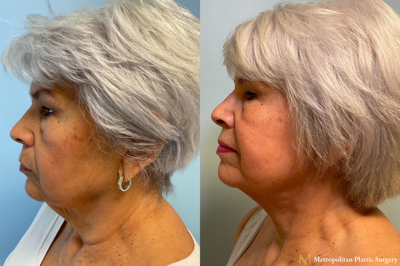 Before and after Facelift & Neck Lift case 41737