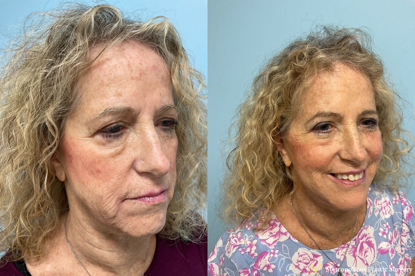 Before and after face lift (rhytidectomy) neck lift from Julia Spears MD - Angle 3