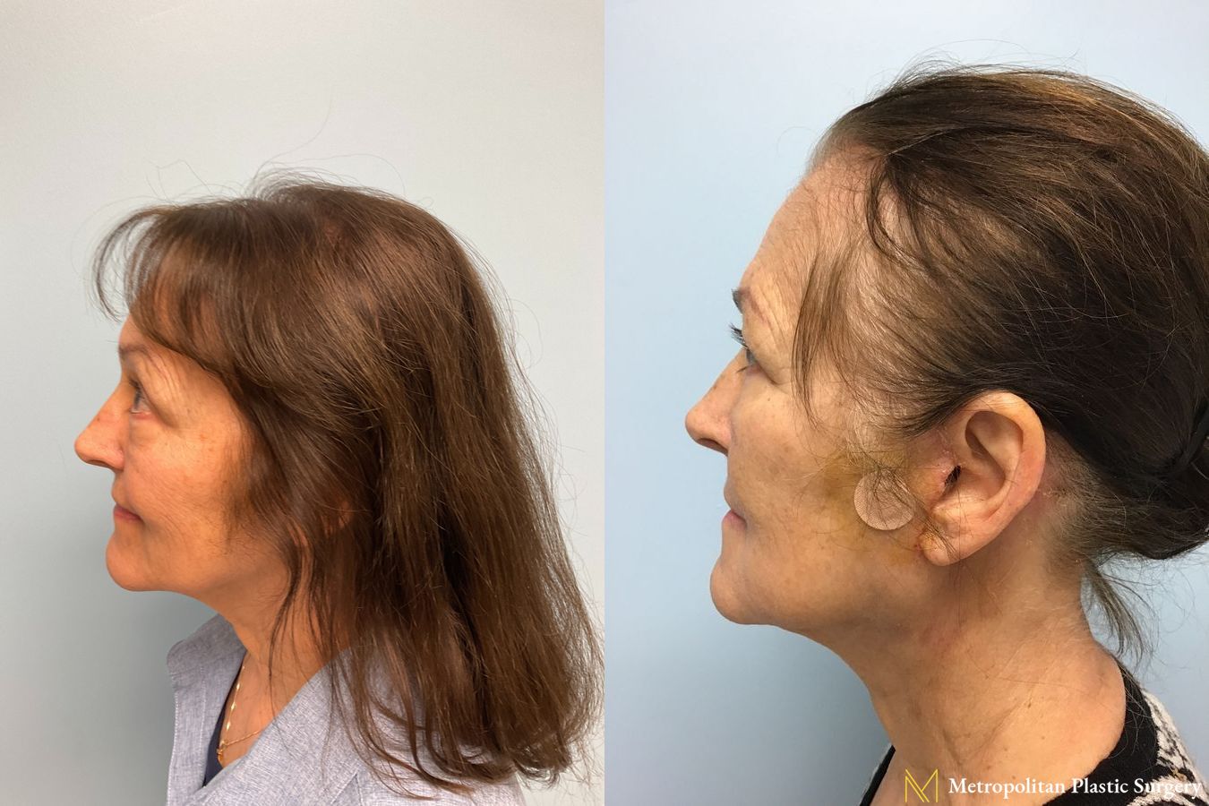 Before and after face lift (rhytidectomy) neck lift from Julia Spears MD - Angle 4