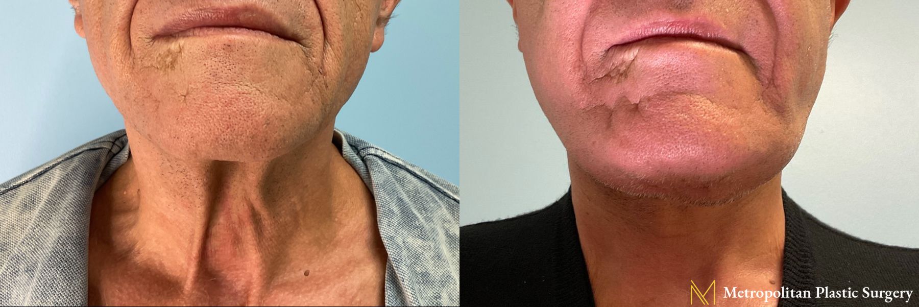 Facelift and Necklift performed by Dr. Julia Spears - Angle 2