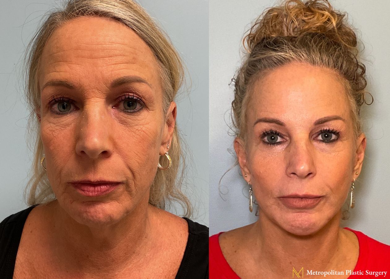 Facelift & Neck Lift with Chin Implant performed by Dr. Julia Spears - Angle 4