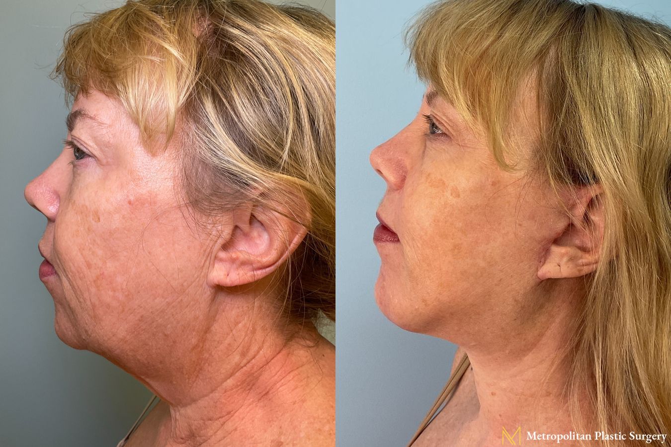 Deep-Plane Face and Necklift with Chin Implant performed by Dr. Julia Spears
