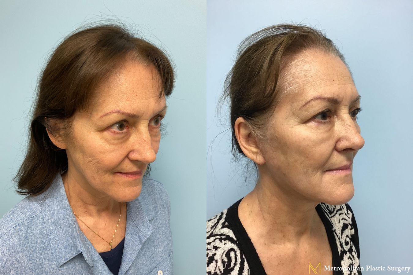 Before and after face lift (rhytidectomy) neck lift from Julia Spears MD - Angle 3