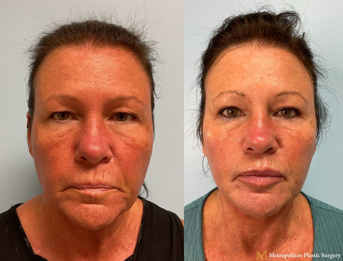 Facelift and Neck Lift with Renuvion performed by Dr. Julia Spears, MS, FACS - Angle 2
