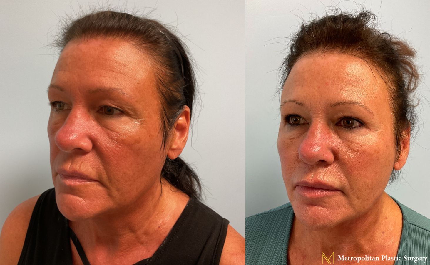 Facelift and Neck Lift with Renuvion performed by Dr. Julia Spears, MS, FACS