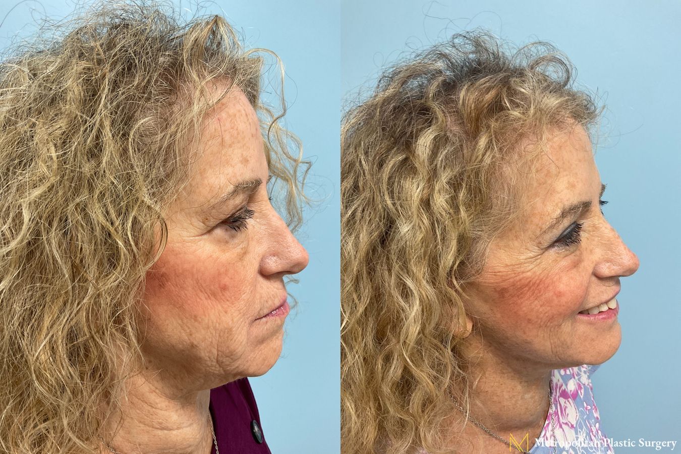 Before and after face lift (rhytidectomy) neck lift from Julia Spears MD - Angle 2