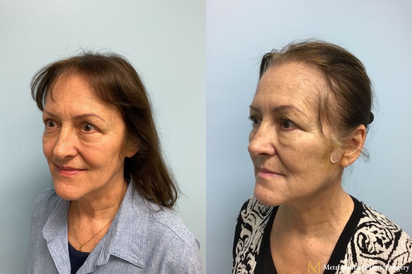 Before and after face lift (rhytidectomy) neck lift from Julia Spears MD - Angle 5