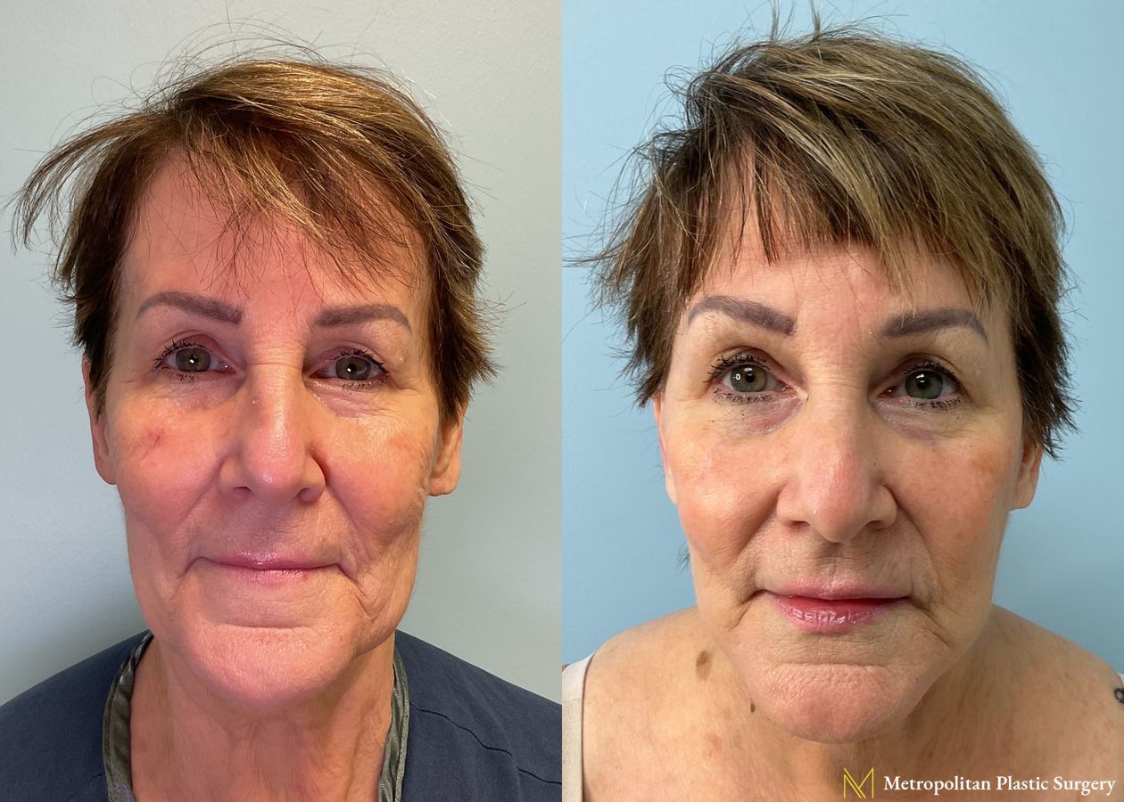 Before and after Facelift & Neck Lift case 23985 - Angle 3
