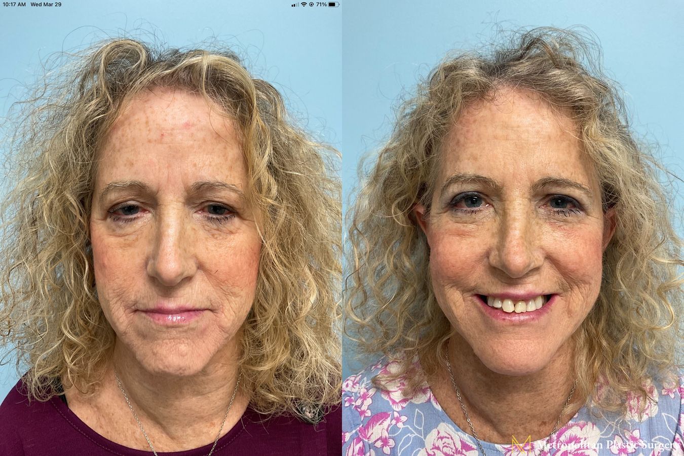 Before and after face lift (rhytidectomy) neck lift from Julia Spears MD