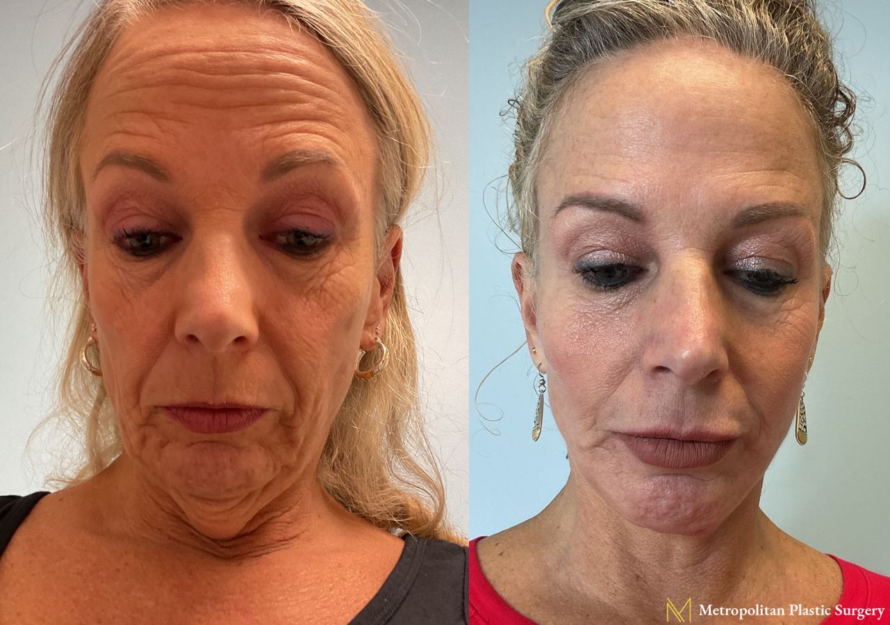 Facelift & Neck Lift with Chin Implant performed by Dr. Julia Spears - Angle 3
