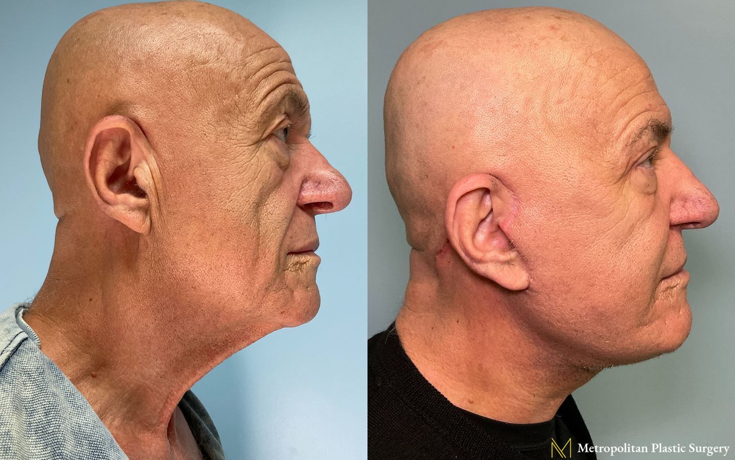 Facelift and Necklift performed by Dr. Julia Spears - Angle 3