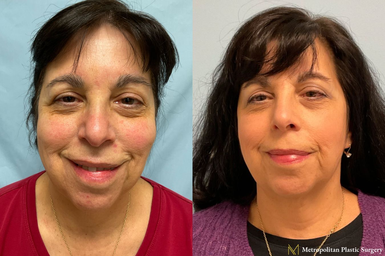 Face and Necklift performed by Dr. Julia Spears - Angle 3