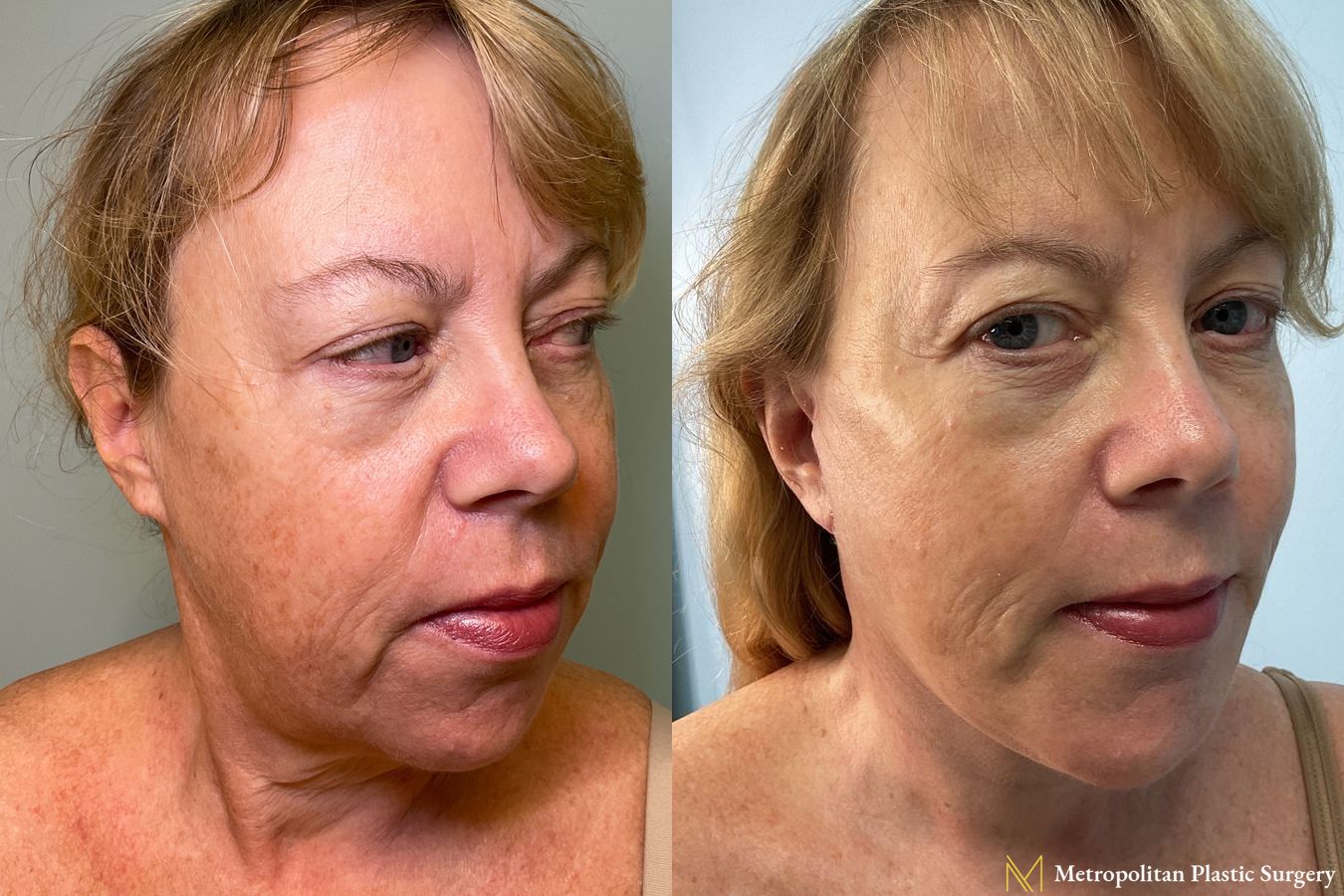 Deep-Plane Face and Necklift with Chin Implant performed by Dr. Julia Spears - Angle 2