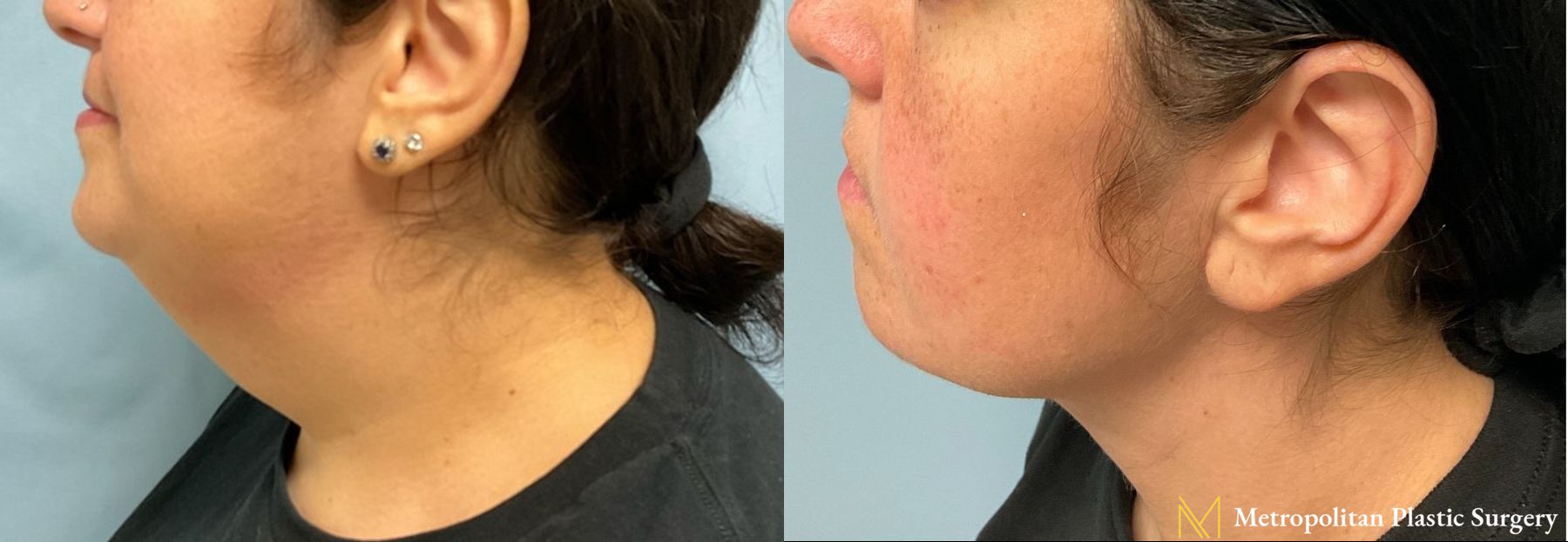 Before and after Facelift & Neck Lift case 8077 - Angle 2