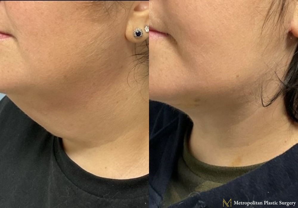 Before and after Facelift & Neck Lift case 8077