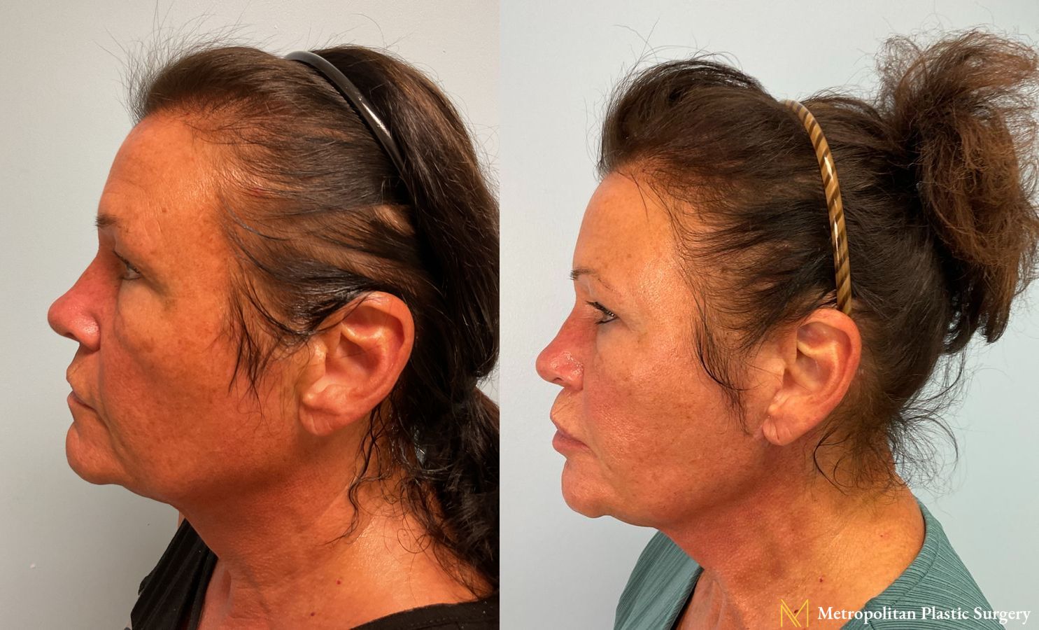 Facelift and Neck Lift with Renuvion performed by Dr. Julia Spears, MS, FACS - Angle 3