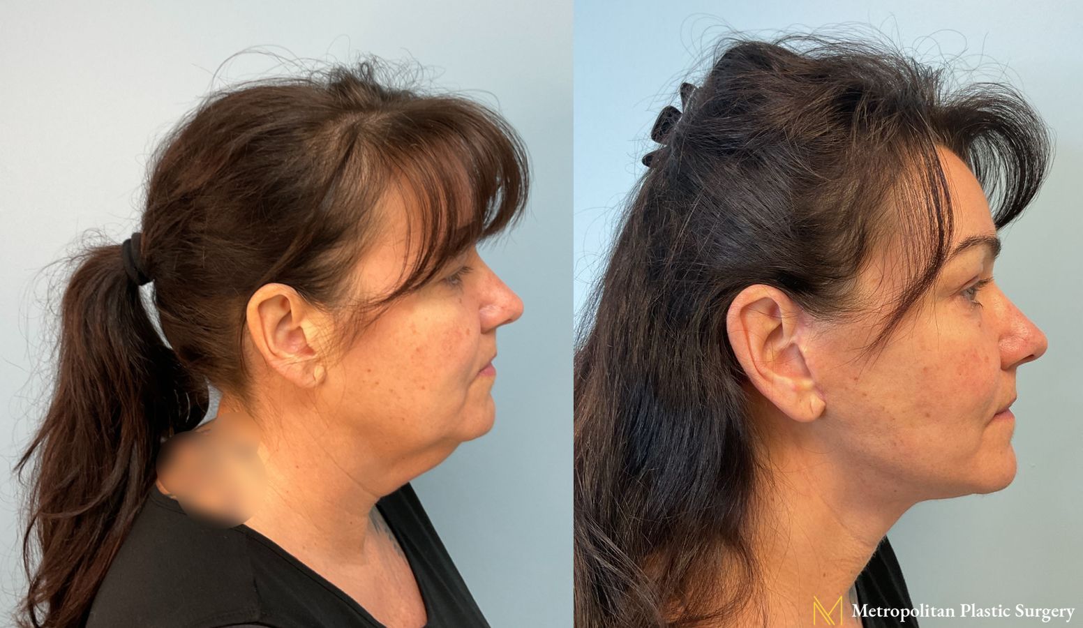 Face and Necklift performed by Dr. Julia Spears, MD, FACS, at Metropolitan Plastic Surgery in Marlton, NJ