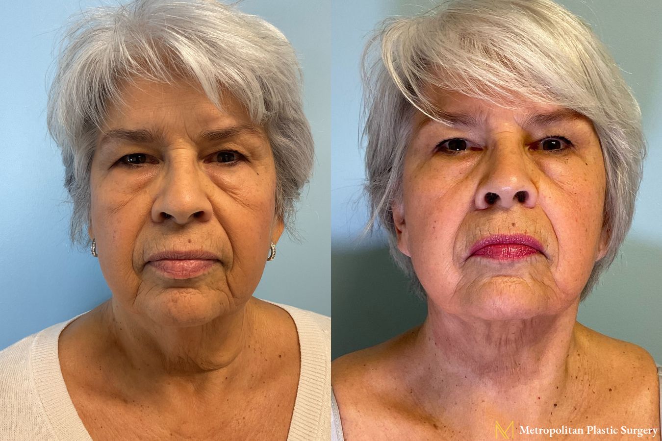 Before and after Facelift & Neck Lift case 41737 - Angle 3