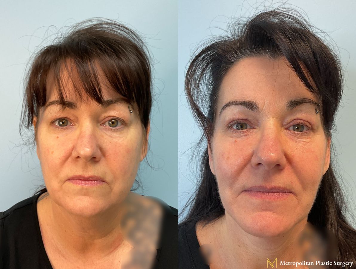Face and Necklift performed by Dr. Julia Spears, MD, FACS, at Metropolitan Plastic Surgery in Marlton, NJ - Angle 2