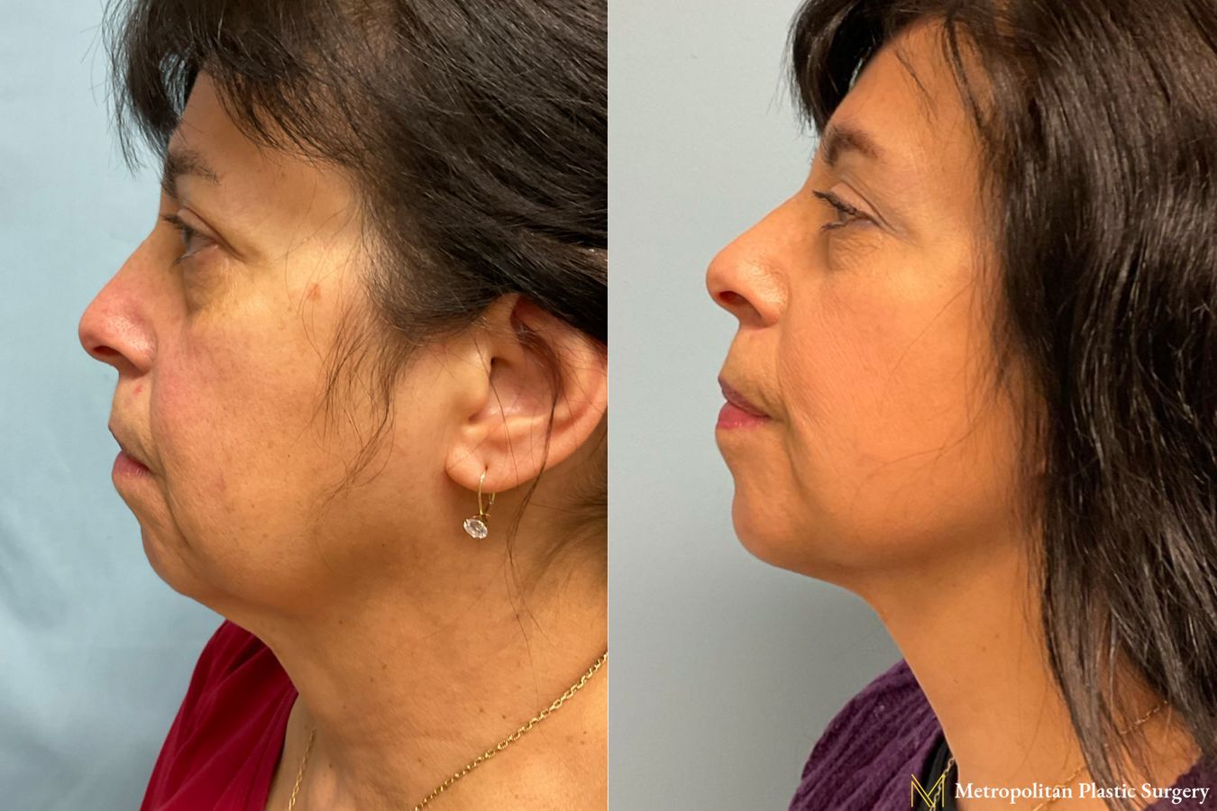 Face and Necklift performed by Dr. Julia Spears