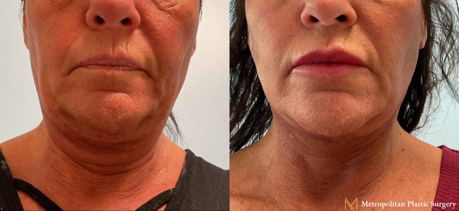 Before and after Facelift & Neck Lift case 23983 - Angle 2