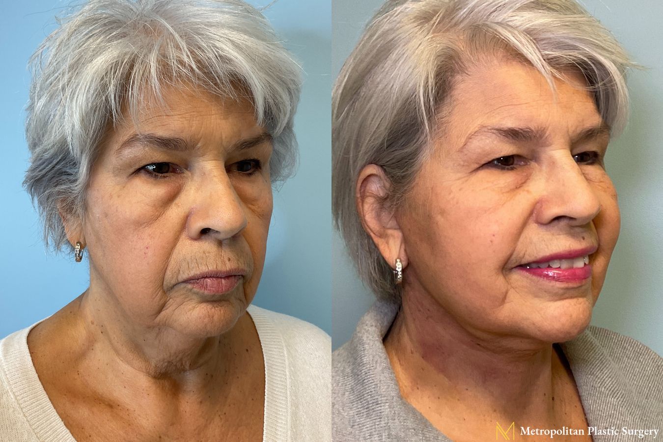Before and after Facelift & Neck Lift case 41737 - Angle 2