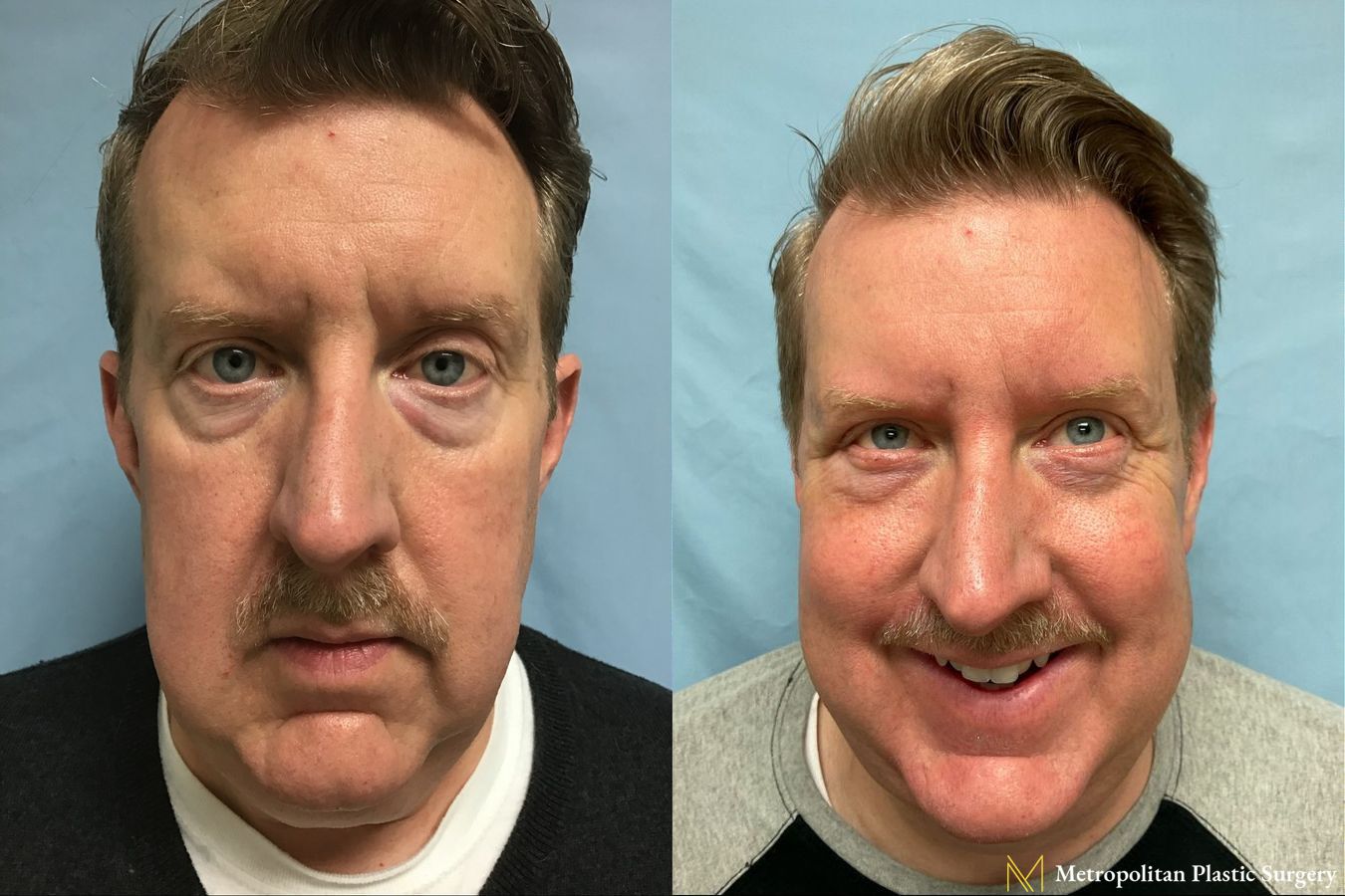 Before and after Lower Blepharoplasty case 8099
