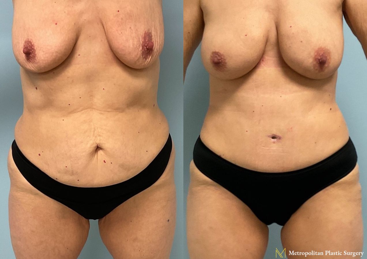 Before and after Tummy Tuck case 11890