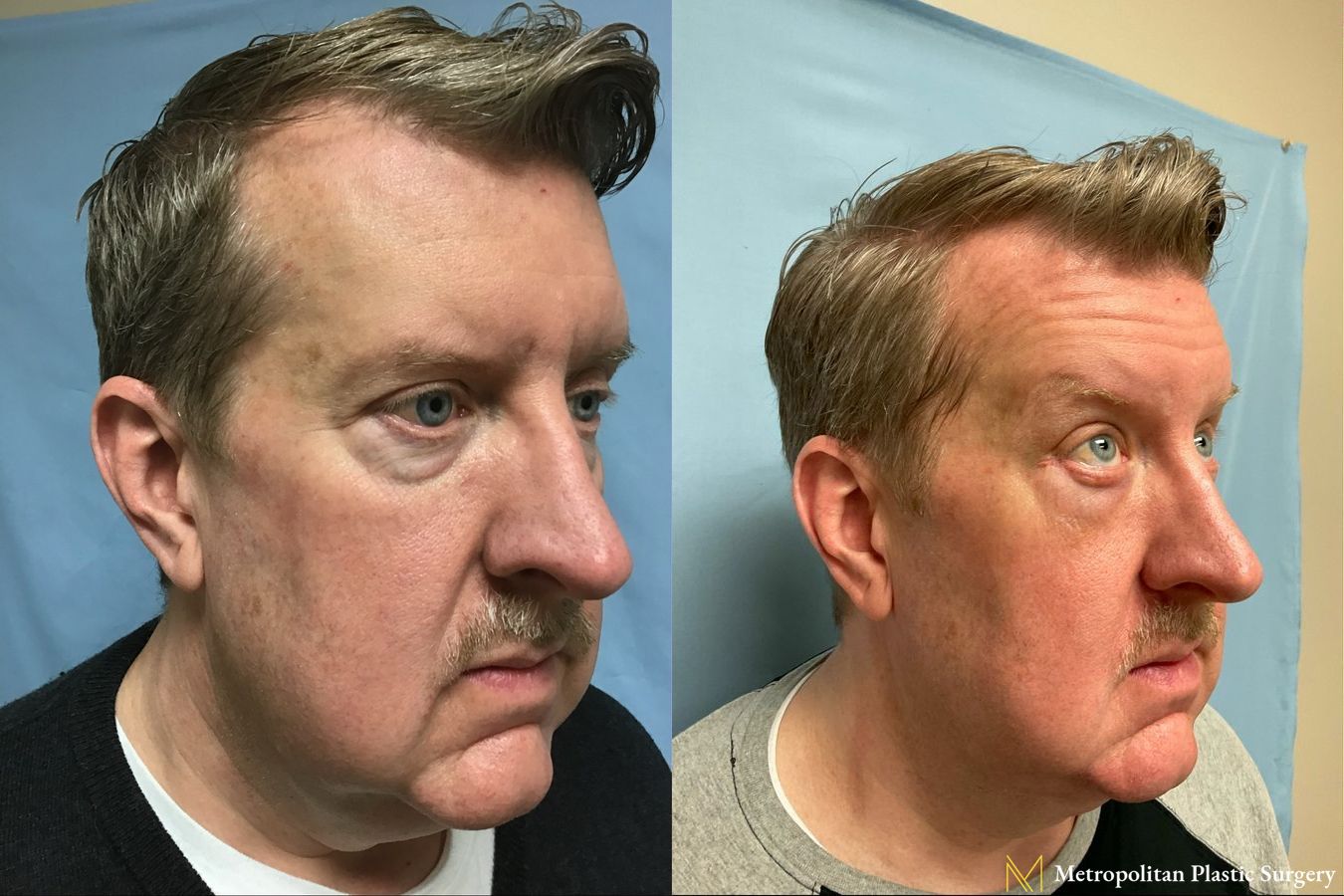 Before and after Lower Blepharoplasty case 8099 - Angle 3