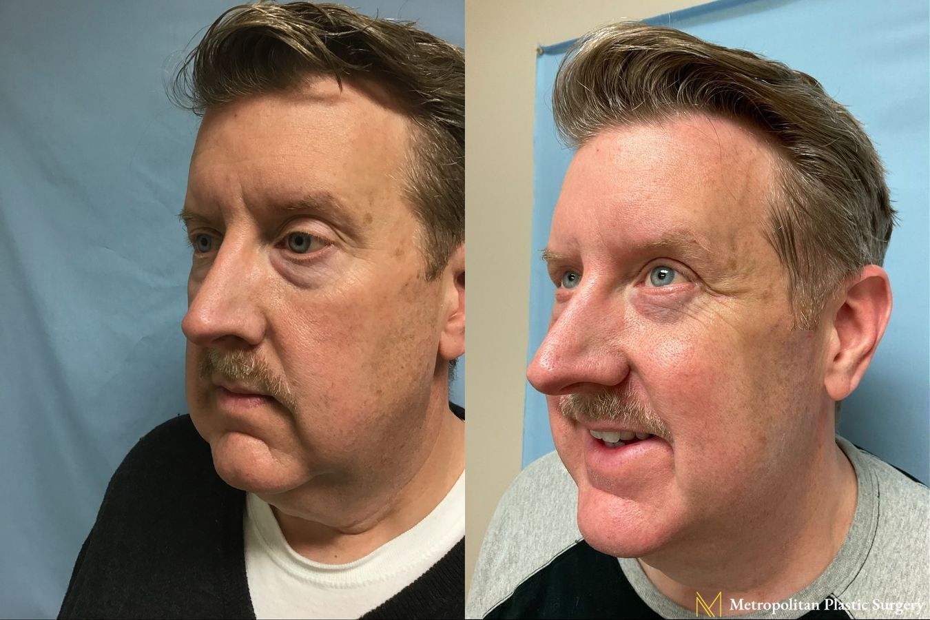 Before and after Lower Blepharoplasty case 8099 - Angle 2