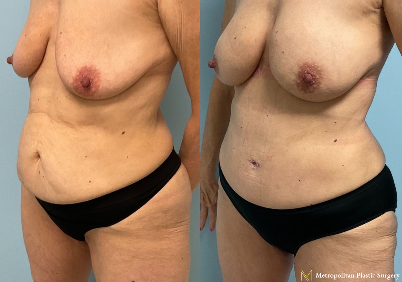 Before and after Tummy Tuck case 11890 - Angle 2