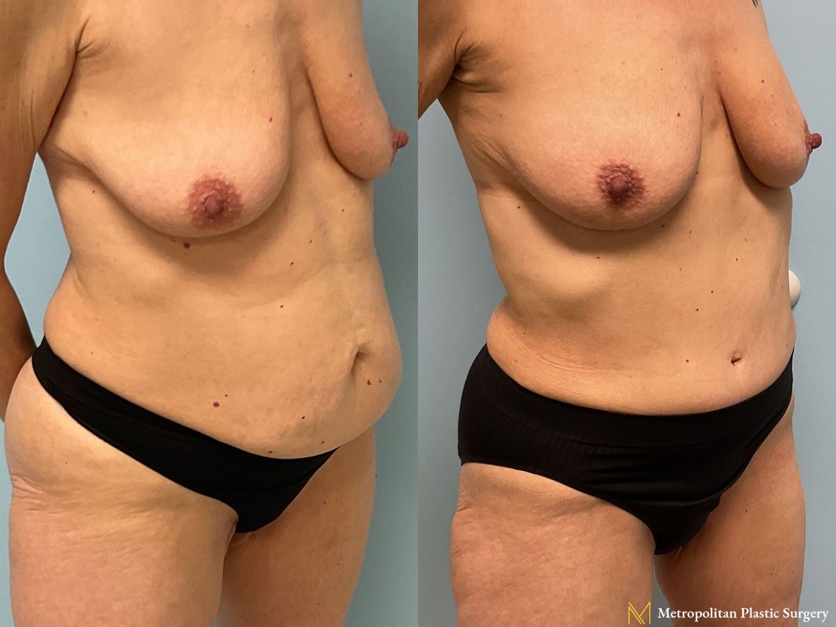 Before and after Tummy Tuck case 11890 - Angle 2