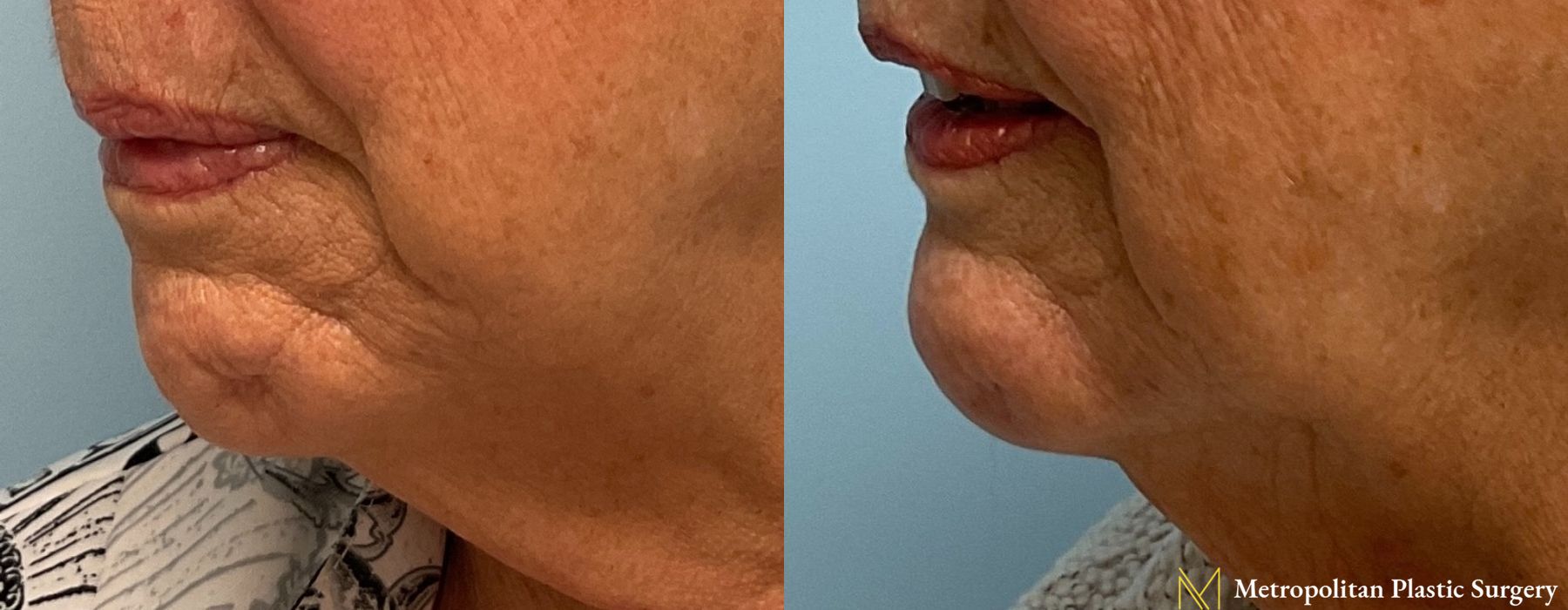 Fillers - Thumbnail 3