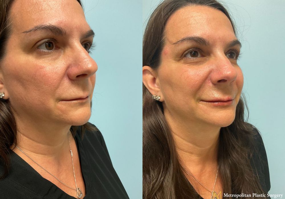 Fillers - Thumbnail 2