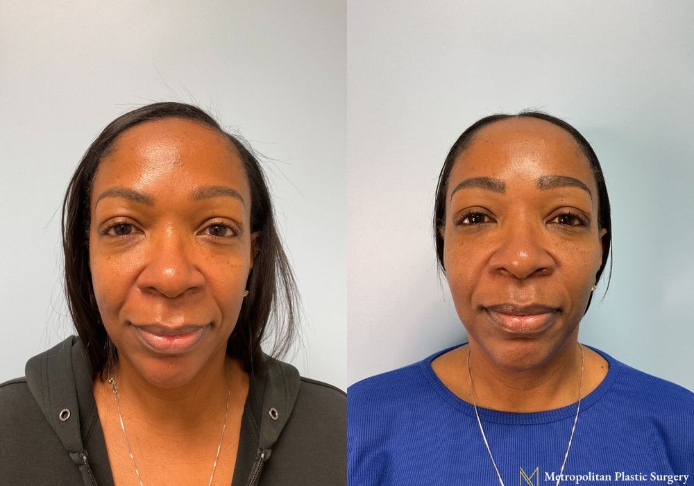 Before and after Fillers case 12363 - Angle 2