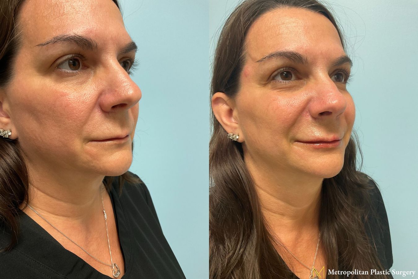 Radiesse dermal filler to erase wrinkles and folds for immediate and long lasting results. - Angle 2