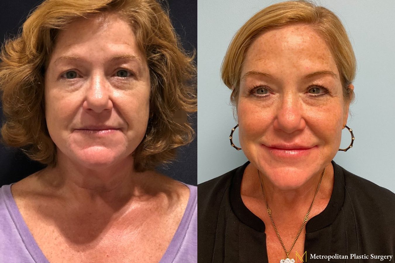 Lip Filler performed by Dr. Julia Spears