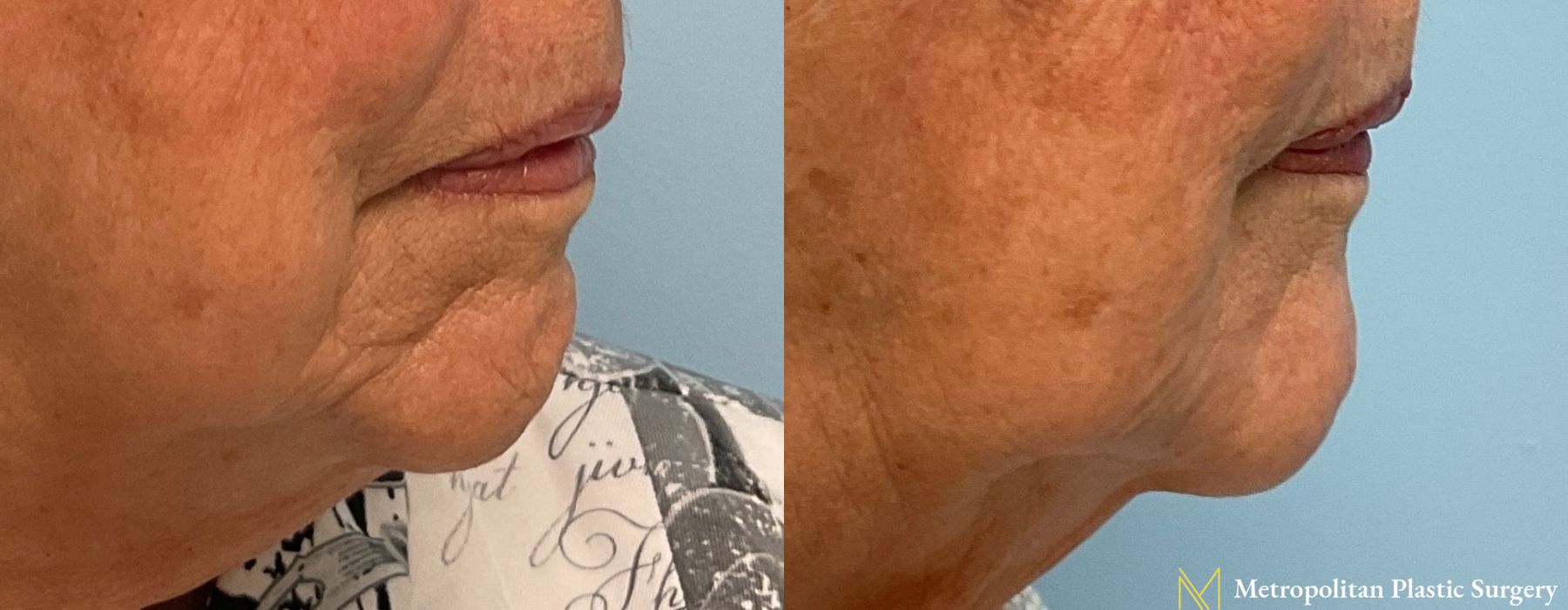 Fillers - Thumbnail 5