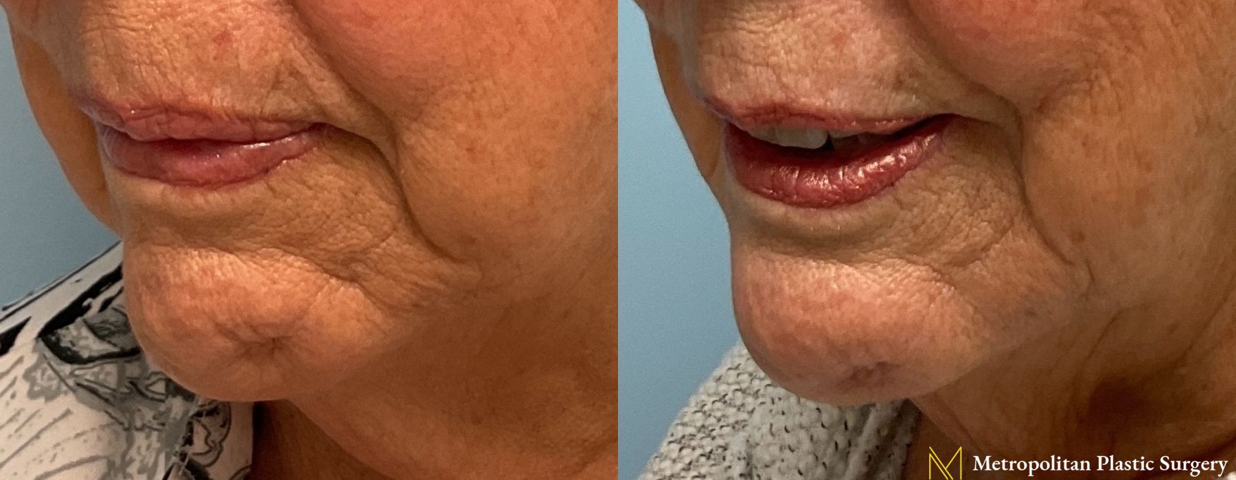 Fillers - Thumbnail 4