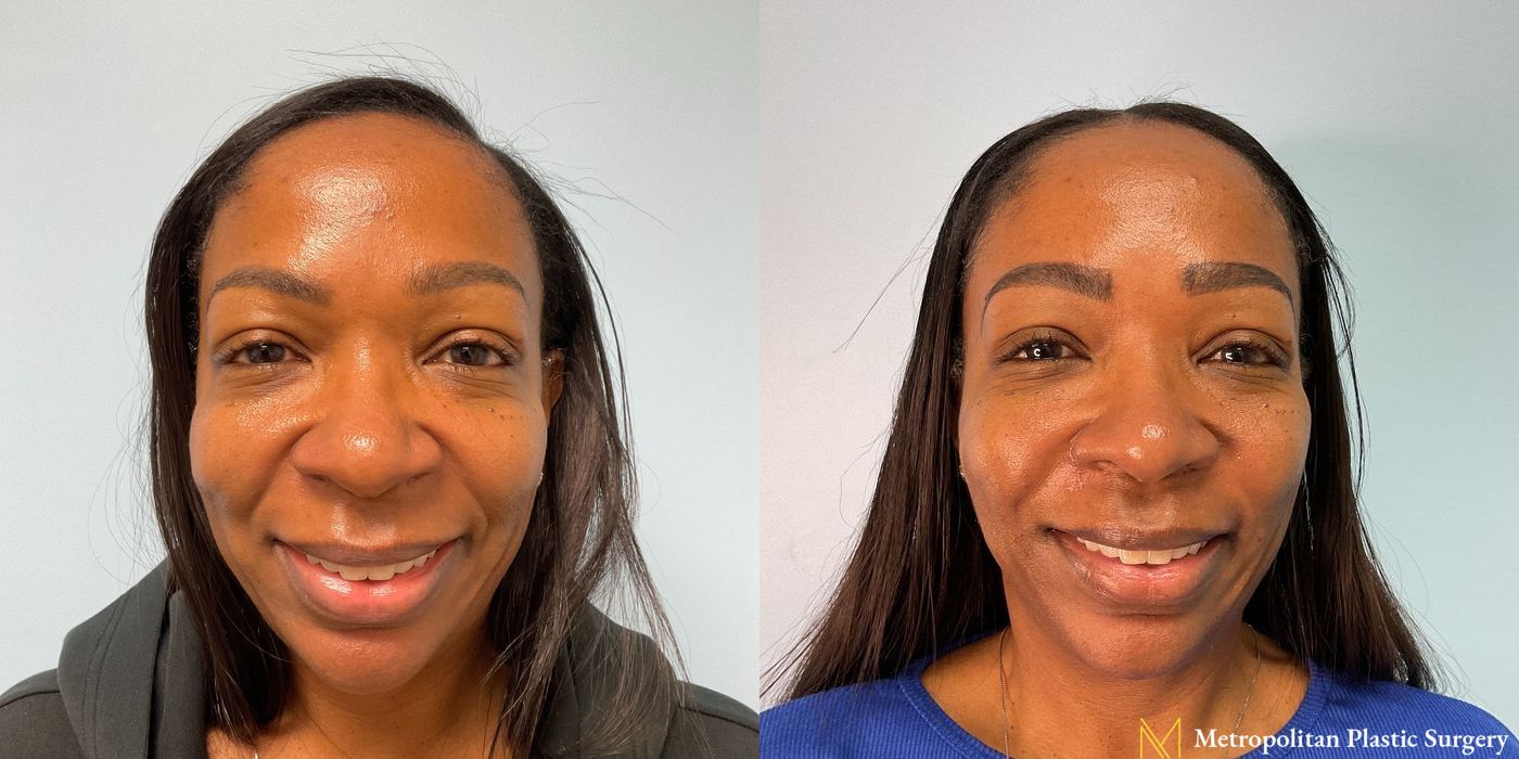 Before and after Fillers case 12363