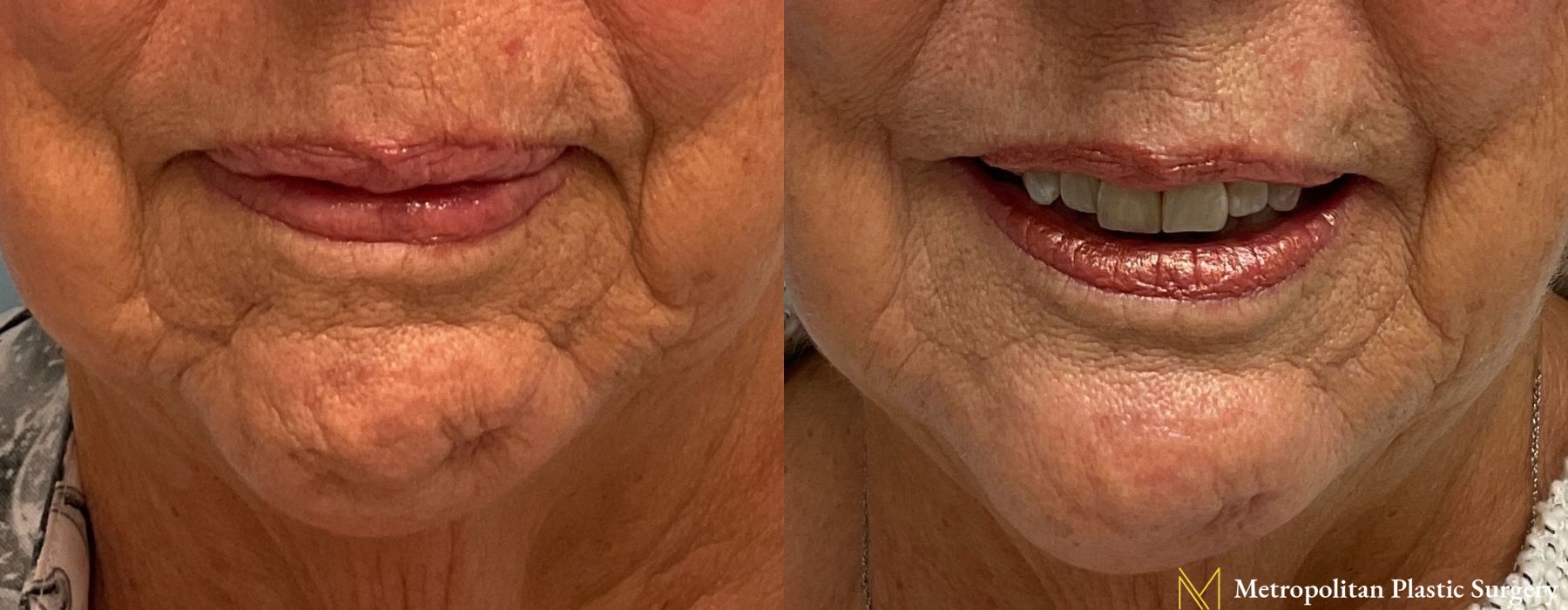 Fillers - Thumbnail 2