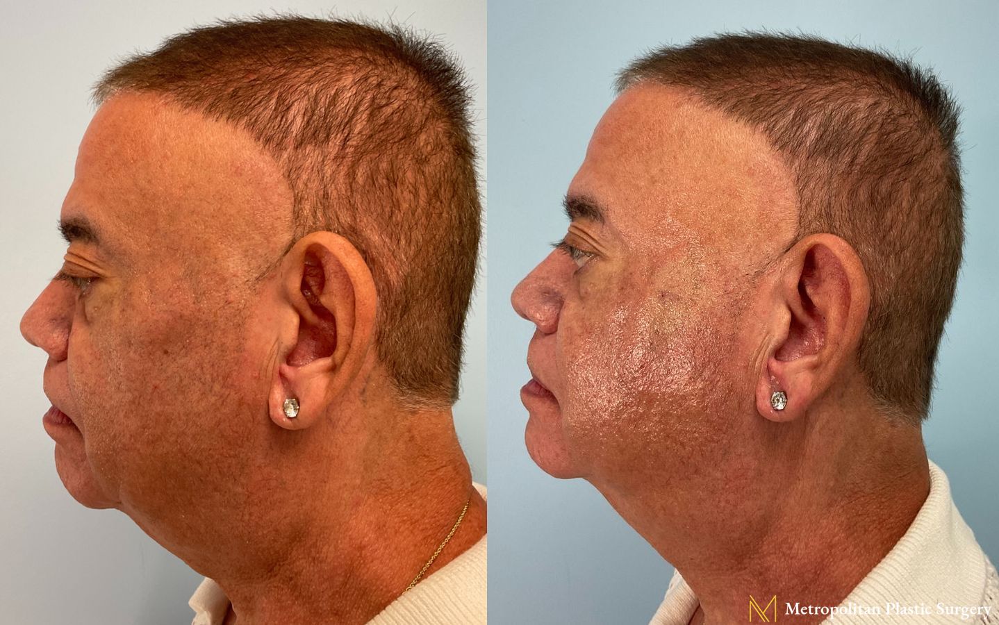 Radiesse Filler in Cheeks performed by Dr. Julia Spears at Metropolitan Plastic Surgery in Marlton, NJ
