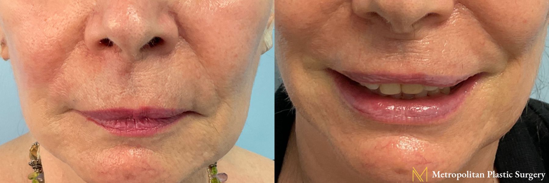 Fillers performed by Dr. Julia Spears