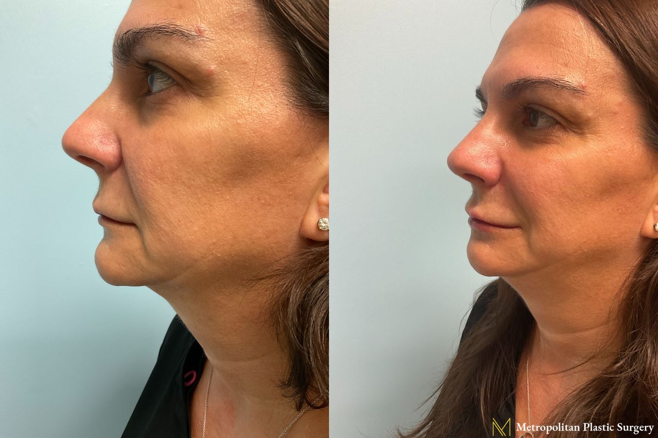 Radiesse dermal filler to erase wrinkles and folds for immediate and long lasting results. - Angle 3
