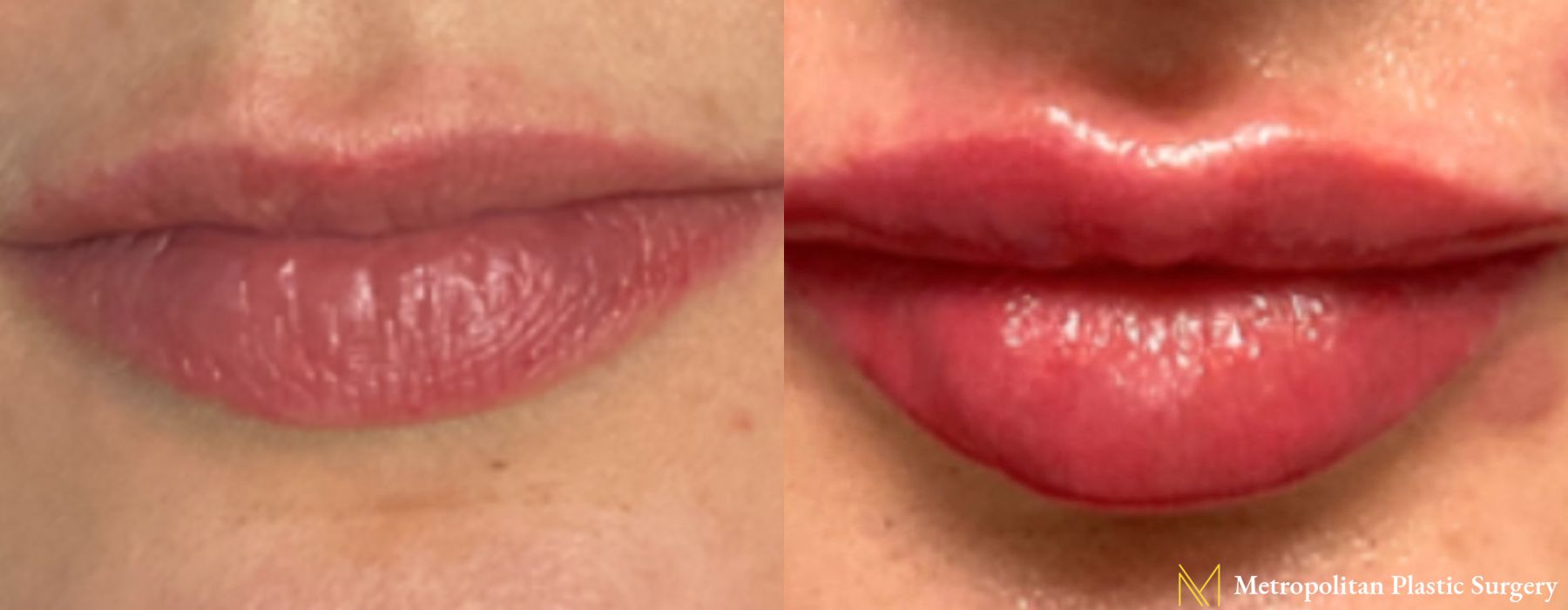 Before and after Fillers case 21701