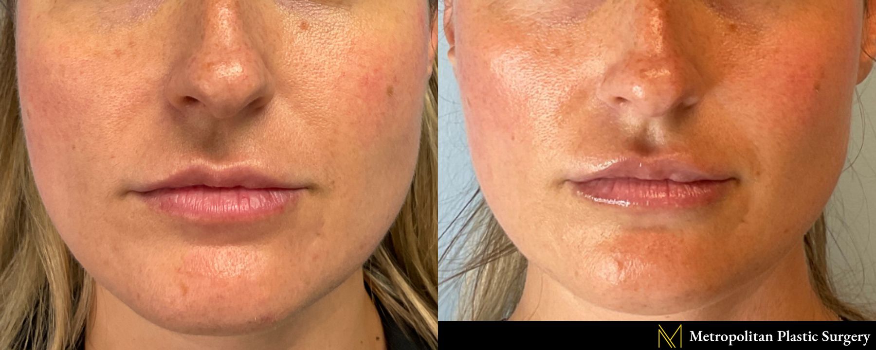 Obagi Magiq Filler in Cheeks performed by Dr. Julia Spears at Metropolitan Plastic Surgery in Marlton, NJ