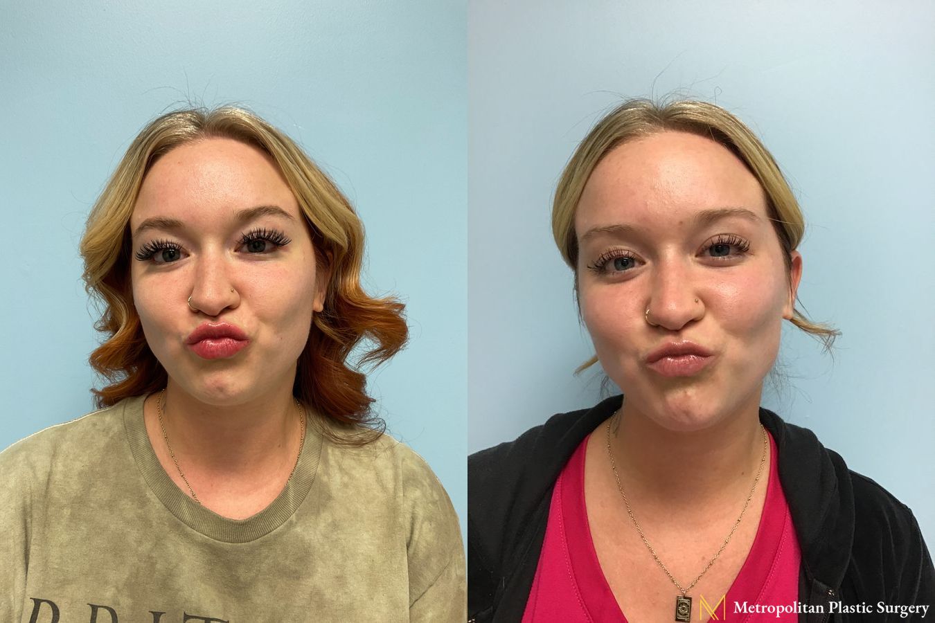 Radiesse dermal filler to erase wrinkles and folds for immediate and long lasting results.