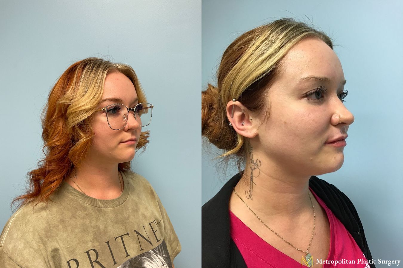 Radiesse dermal filler to erase wrinkles and folds for immediate and long lasting results. - Angle 3